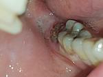 Tooth extracted 3 days ago. Is this infected?-20171221_185503-jpg