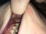 Wisdom tooth extraction concerns-img_3593-jpg