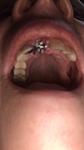 Very hard, painful lump in gum after extraction??-5847acac-1e90-43a7-b6c1-be1767924fbb-jpeg