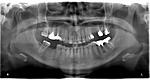 Hard lump following apicoectomy and tooth extraction-whatsapp-image-2020-06-08-11-05-09-jpg