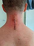 Cervical surgery or not: What to do with conflicting recommendations-image000000-2-jpg