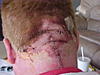 Been A Long Time--Opinions Requested-staples-scs-implant-ouch-jpg