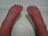 RSD Photos and Pictures Thread-deformity-causalgia-severe-edema-feet-jpg