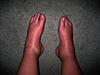 RSD Photos and Pictures Thread-rsd-feet-jan-2008-severe-edema-deformation-sympathetic-block-jpg