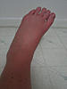 RSD Photos and Pictures Thread-severe-edema-causalgia-lft-foot-jpg