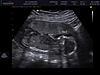Pregnancy and MS-3d-baby_0000-jpg