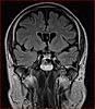 Colloid Cyst or just choroid plexus?-2-jpg