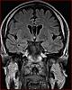 Colloid Cyst or just choroid plexus?-4-jpg