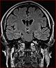 Colloid Cyst or just choroid plexus?-5-jpg