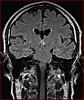 Colloid Cyst or just choroid plexus?-6-jpg