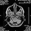 Please Help!  MRI Images..What is that?-jpg