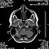 Please Help!  MRI Images..What is that?-b3-jpg