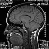 HELP! Does this look like Chiari I to you??-0099-jpg