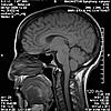 HELP! Does this look like Chiari I to you??-0100-jpg