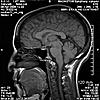 HELP! Does this look like Chiari I to you??-0101-jpg