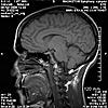 HELP! Does this look like Chiari I to you??-0102-jpg