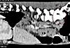 Question on CTSCAN image - Is vertebrae right on vertebrae normal?-low-jpg
