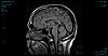 2 yrs of various symptoms-mra-mri-brain-2007-jpg