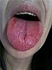 Is RSD in the tongue possible?-getattachment-jpg