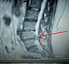 L4-L5 decompression (poss. fusion) surgery next week ... scared!-spine-jpg