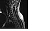 C5 Injury - MRI Help-2-jpg