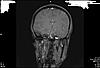 MRI for migraines-0122e380-jpg