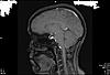 MRI for migraines-0122627f-jpg