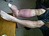 RSD in foot/leg since 2002-grande-prairie-20110827-00061-800x600-jpg