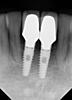 I need help bad, Please. Dental implants-ray-1-jpg