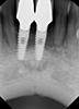 I need help bad, Please. Dental implants-ray-2-jpg