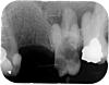 tooth extraction when root is in sinus cavity-fig1-jpg