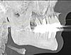 Orthodontics, implant and a constant, dull pressure-scan01-jpg