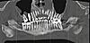 Orthodontics, implant and a constant, dull pressure-scan02-jpg