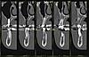 Orthodontics, implant and a constant, dull pressure-scan03-jpg