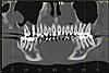 Orthodontics, implant and a constant, dull pressure-scan05-jpg