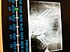 Living with Spinal Fusion due to Scoliosis-photo-13-jpg