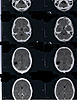 Whats causing my seizures and help understanding MRI report-ccf02142012_00002-jpg
