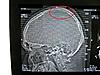 Skull dent from birth injury-img_0517-copy-jpg