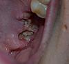 12 days post extraction... and in pain!-tooth-extraction-jpg