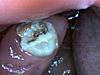 broken decayed wisdom tooth etc...-securedownload-1-jpeg