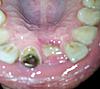 Exposed bone graft, what is the infection probability?-bone-jpg