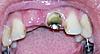 Exposed bone graft, what is the infection probability?-gum-jpg