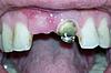 Exposed bone graft, what is the infection probability?-gum-2-jpg