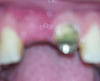 Exposed bone graft, what is the infection probability?-front-jpg