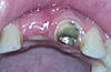 Exposed bone graft, what is the infection probability?-jpg