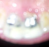 Exposed bone graft, what is the infection probability?-crown-jpg