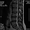 L-4 L-5 Disc    -  MRI Question-mri-jpg
