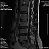 L-4 L-5 Disc    -  MRI Question-mri2-jpg