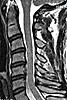 C Spine help reading mri-image-jpg