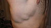 Serratus anterior dysfunction(swimmer's shoulder)-rightserratus-jpg